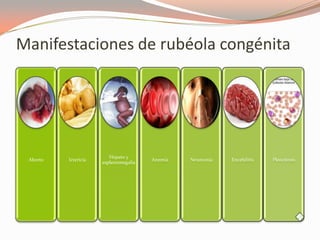 Manifestaciones de rubéola congénita
Aborto Ictericia
Hepato y
esplenomegalia
Anemia Neumonía Encefalitis Pleocitosis
 