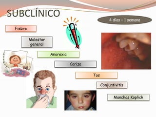SUBCLÍNICO
Fiebre
Conjuntivitis
Tos
Malestar
general
4 días – 1 semana
Anorexia
Coriza
Manchas Koplick
 