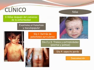 CLÍNICO 5días
3-4días después del comienzo
de la enfermedad
Exantema eritematoso
y maculopapular
Día 1: Detrás de
pabellones auriculares
Día 2 y 3: Tronco y extremidades
(plantas y palmas)
Día 4: aspecto pardo
Descamación
 