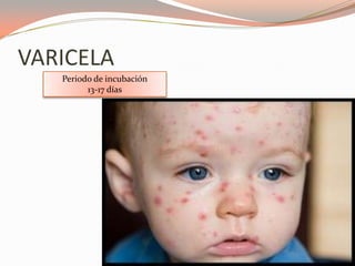 VARICELA
Periodo de incubación
13-17 días
 