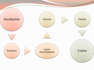 Incubación
Exantema
Lesión
maculopapular
Vesícula Pústula
Costra
 