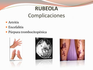 RUBEOLA
Complicaciones
 Artritis
 Encefalitis
 Púrpura trombocitopénica
 