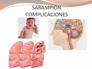 SARAMPIÓN
COMPLICACIONES
 