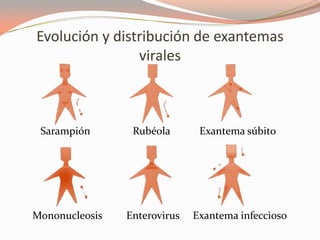 Evolución y distribución de exantemas
virales
Sarampión Rubéola Exantema súbito
Mononucleosis Enterovirus Exantema infeccioso
 