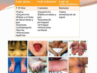 FASE AGUDA FASE SUBAGUDA FASE DE
CONVALECENCIA
7-14 Días 3 semanas 8semanas
•Fiebre
•Conjuntivitis
•Edema y eritema
de labios manos y
pies
•Exantema
•Linfadenopatía
•Diarrea
•Alteraciones
hepáticas
•Conjuntivitis
•Edema en manos y
pies
•Descamación
periungueal
•Artralgias
•Alteraciones
cardiacas
•Hasta
normalización de
signos
 