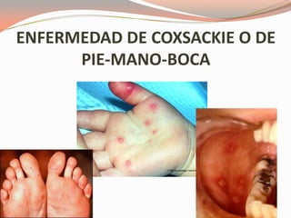 ENFERMEDAD DE COXSACKIE O DE
PIE-MANO-BOCA
 