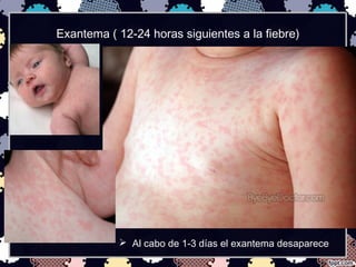 Exantema ( 12-24 horas siguientes a la fiebre)
 Al cabo de 1-3 días el exantema desaparece
 