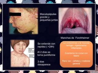Se extiende con
rapidez ( <24h)
Maculopápulas
grande y
pequeñas juntas
Al 2 días se
torna puntiforme
Manchas de Forchheimer
3 dias
desaparece
La conjuntivas y la mucosa
faringe – ligeramente
inflamadas
Exantema no cursa con
fiebre
Rara vez : cefalea y malestar
general
 