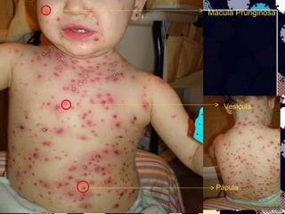 Pápula
Vesícula
Macula Pruriginosa
 