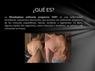 ¿QUÉ ES?
La fibrodisplasia osificante progresiva (FOP) es una enfermedad
hereditaria, autosómica dominante, que provoca una osificación progresiva
de los músculos esqueléticos, fascias, tendones y ligamentos. Es decir,
algunos tejidos del organismo, como músculos o tendones, se osifican y se
convierten en hueso.
 