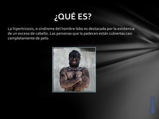 ¿QUÉ ES?
La hipertricosis, o síndrome del hombre lobo es destacada por la existencia
de un exceso de cabello. Las personas que la padecen están cubiertas casi
completamente de pelo.
 