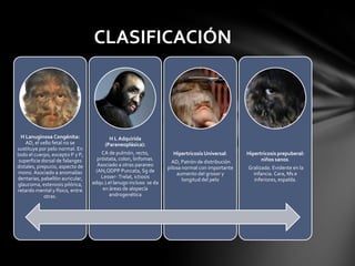 CLASIFICACIÓN



  H Lanuginosa Congénita:               H L Adquirida
    AD, el vello fetal no se          (Paraneoplásica):
sustituye por pelo normal. En
todo el cuerpo, excepto P y P,       CA de pulmón, recto,           Hipertricosis Universal:     Hipertricosis prepuberal:
 superficie dorsal de falanges     próstata, colon, linfomas.                                          niños sanos.
                                                                    AD, Patrón de distribución
distales, prepucio, aspecto de     Asociado a otras paraneo
                                                                  pilosa normal con importante   Gralizada. Evidente en la
 mono. Asociado a anomalías       (AN,QDPP Puncata, Sg de
                                                                      aumento del grosor y         infancia. Cara, Ms e
dentarias, pabellón auricular,       Lesser- Trelat, ictiosis
                                                                         longitud del pelo         inferiores, espalda.
glaucoma, estenosis pilórica,    adqu.).el lanugo incluso se da
retardo mental y físico, entre        en áreas de alopecía
             otras.                      androgenética
 
