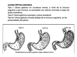 ULCERA PÉPTICA GÁSTRICA
Tipo I: Ulcera gástrica en curvatura menor, a nivel de la incisura
angularis o por encima, se acompaña con valores normales o bajos de
ácido clorhídrico.
Tipo II: Ulcera gástrica asociada a ulcera duodenal.
Tipo III: Ulcera gástrica situada debajo de la incisura angularis, en las
proximidades del píloro.
 