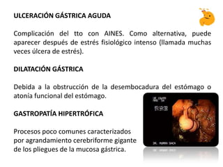 ULCERACIÓN GÁSTRICA AGUDA
Complicación del tto con AINES. Como alternativa, puede
aparecer después de estrés fisiológico intenso (llamada muchas
veces úlcera de estrés).
DILATACIÓN GÁSTRICA
Debida a la obstrucción de la desembocadura del estómago o
atonía funcional del estómago.
GASTROPATÍA HIPERTRÓFICA
Procesos poco comunes caracterizados
por agrandamiento cerebriforme gigante
de los pliegues de la mucosa gástrica.
 
