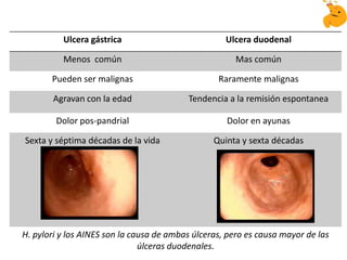 Ulcera gástrica Ulcera duodenal
Menos común Mas común
Pueden ser malignas Raramente malignas
Agravan con la edad Tendencia a la remisión espontanea
Dolor pos-pandrial Dolor en ayunas
Sexta y séptima décadas de la vida Quinta y sexta décadas
H. pylori y los AINES son la causa de ambas úlceras, pero es causa mayor de las
úlceras duodenales.
 