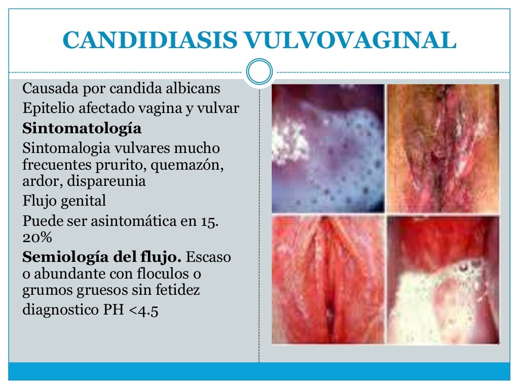 ENFERMEDADES GINECOLOGICAS E ENFERMEDADES PELVICAS INFLAMATORIAS ENFERMEDADES GINECOLOGICAS E ENFERMEDADES PELVICAS INFLAMATORIAS