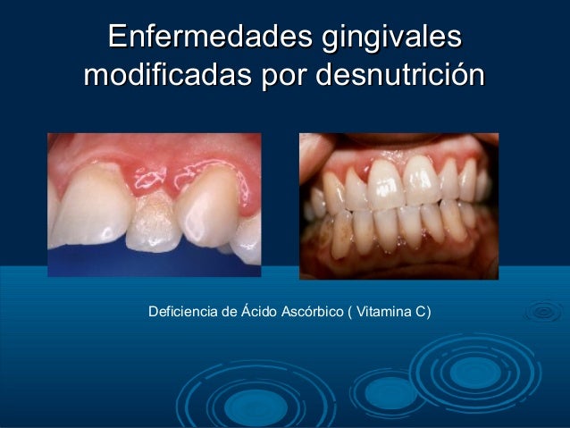 Enfermedades gingivales inducida por factores sistemicos