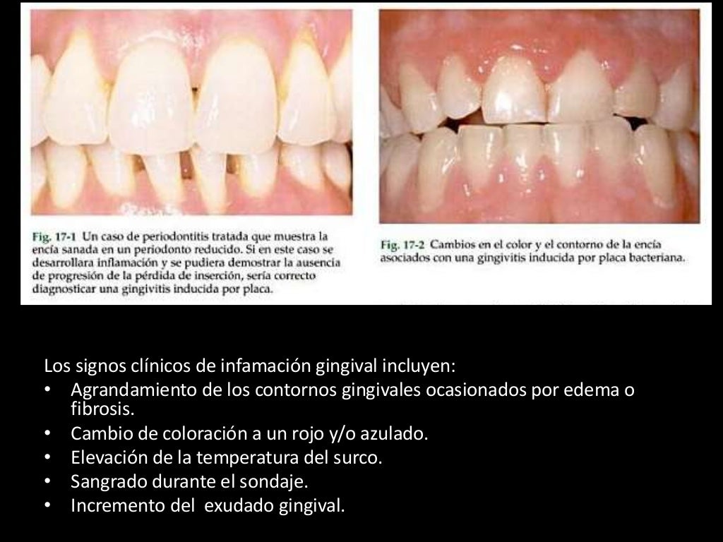 Enfermedades gingivales inducidas por la placa bacteriana