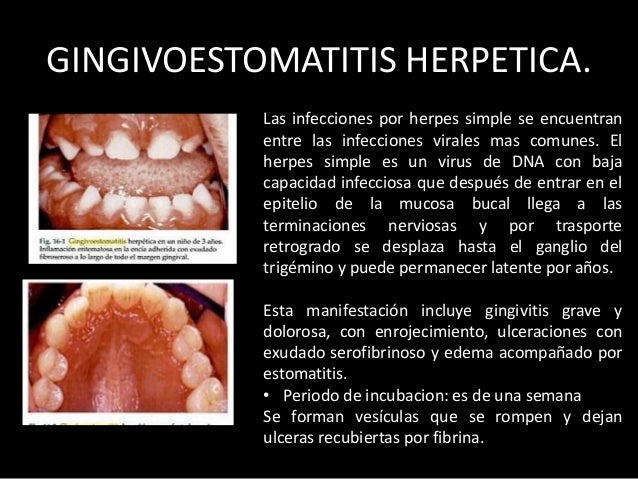 Enfermedades gingivales inducidas por la placa bacteriana