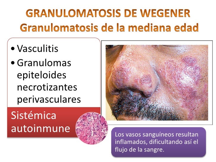 Enfermedades granulomatosas, wegener, rinoescleroma y ...