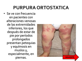 PURPURA ORTOSTATICA
• Se ve con frecuencia
en pacientes con
alteraciones venosas
de las extremidades
inferiores, los que
después de estar de
pie por períodos
prolongados
presentan petequias
y equímosis en
muslos y,
especialmente, en
piernas.
 
