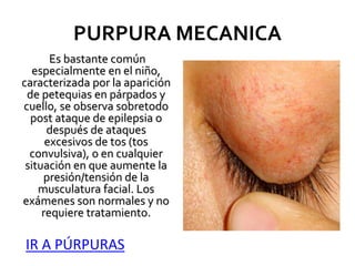 PURPURA MECANICA
Es bastante común
especialmente en el niño,
caracterizada por la aparición
de petequias en párpados y
cuello, se observa sobretodo
post ataque de epilepsia o
después de ataques
excesivos de tos (tos
convulsiva), o en cualquier
situación en que aumente la
presión/tensión de la
musculatura facial. Los
exámenes son normales y no
requiere tratamiento.
IR A PÚRPURAS
 