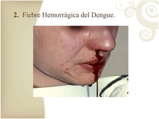 2. Fiebre Hemorrágica del Dengue. 
 