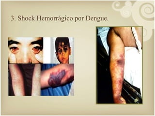 3. Shock Hemorrágico por Dengue. 
 