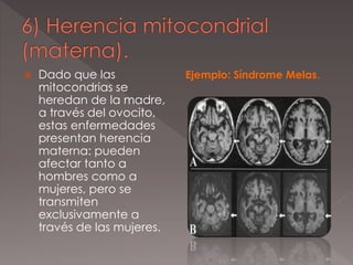  Dado que las
mitocondrias se
heredan de la madre,
a través del ovocito,
estas enfermedades
presentan herencia
materna: pueden
afectar tanto a
hombres como a
mujeres, pero se
transmiten
exclusivamente a
través de las mujeres.
Ejemplo: Síndrome Melas.
 