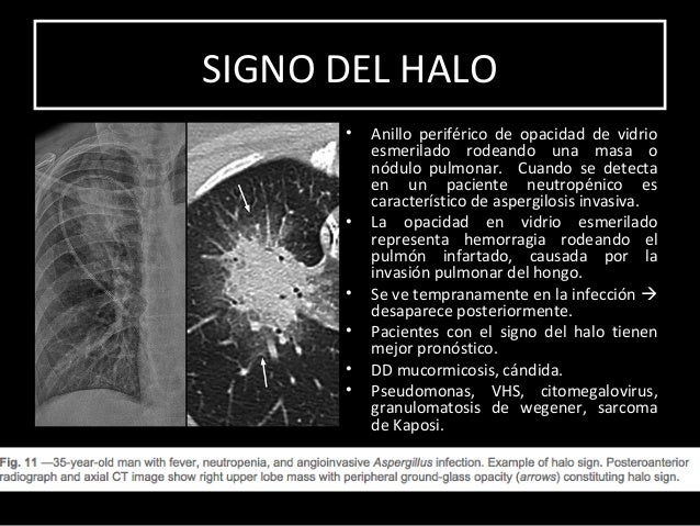 SIGNOS Y PATRONES CLASICOS DE PATOLOGIA PULMONAR EN TC