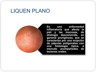 LIQUEN PLANO
 