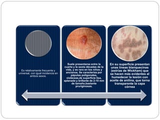 Es relativamente frecuente y
universal, con igual incidencia en
ambos sexos.
Suele presentarse entre la
cuarta y la sexta décadas de la
vida, y es rara en los niños y
ancianos. Se caracteriza por
pápulas poligonales,
violáceas,de superficie lisa,
aplanada y brillante de 2-10 mm
de tamaño,bastante
pruriginosas.
En su superficie presentan
unas líneas blanquecinas
(estrías de Wickham) que
se hacen más evidentes al
humedecer la lesión con
aceite de anilina, que torna
transparente la capa
córnea
 