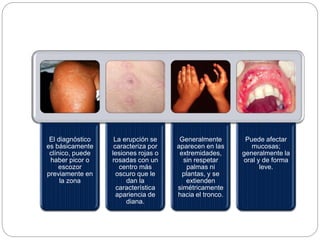 El diagnóstico
es básicamente
clínico, puede
haber picor o
escozor
previamente en
la zona
La erupción se
caracteriza por
lesiones rojas o
rosadas con un
centro más
oscuro que le
dan la
característica
apariencia de
diana.
Generalmente
aparecen en las
extremidades,
sin respetar
palmas ni
plantas, y se
extienden
simétricamente
hacia el tronco.
Puede afectar
mucosas;
generalmente la
oral y de forma
leve.
 