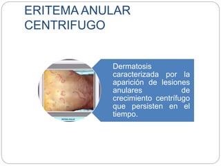 ERITEMA ANULAR
CENTRIFUGO
Dermatosis
caracterizada por la
aparición de lesiones
anulares de
crecimiento centrífugo
que persisten en el
tiempo.
 