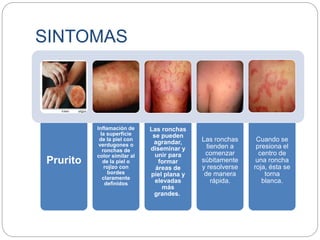SINTOMAS
Prurito
Inflamación de
la superficie
de la piel con
verdugones o
ronchas de
color similar al
de la piel o
rojizo con
bordes
claramente
definidos
Las ronchas
se pueden
agrandar,
diseminar y
unir para
formar
áreas de
piel plana y
elevadas
más
grandes.
Las ronchas
tienden a
comenzar
súbitamente
y resolverse
de manera
rápida.
Cuando se
presiona el
centro de
una roncha
roja, ésta se
torna
blanca.
 