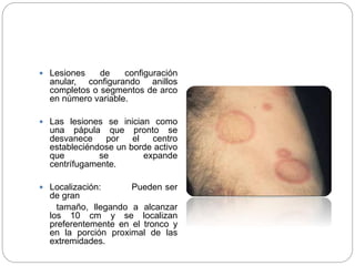  Lesiones de configuración
anular, configurando anillos
completos o segmentos de arco
en número variable.
 Las lesiones se inician como
una pápula que pronto se
desvanece por el centro
estableciéndose un borde activo
que se expande
centrífugamente.
 Localización: Pueden ser
de gran
tamaño, llegando a alcanzar
los 10 cm y se localizan
preferentemente en el tronco y
en la porción proximal de las
extremidades.
 