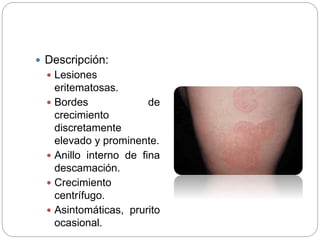  Descripción:
 Lesiones
eritematosas.
 Bordes de
crecimiento
discretamente
elevado y prominente.
 Anillo interno de fina
descamación.
 Crecimiento
centrífugo.
 Asintomáticas, prurito
ocasional.
 