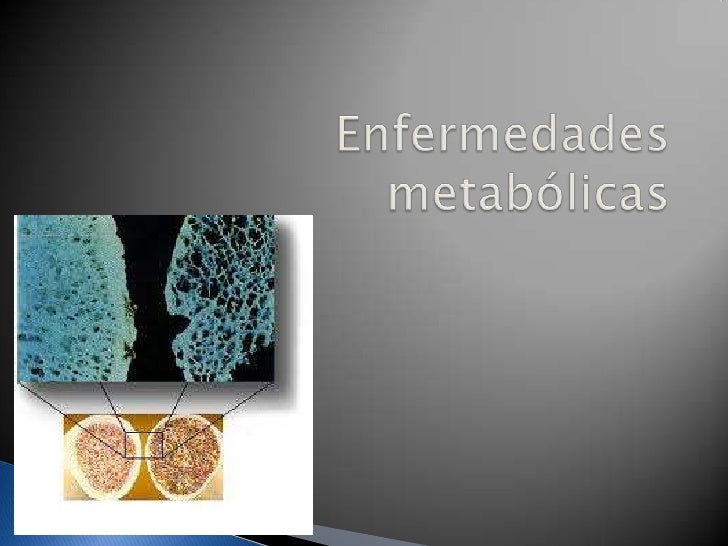Enfermedades metabólicas de hueso Enfermedades metabólicas de hueso
