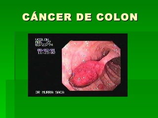 CÁNCER DE COLON