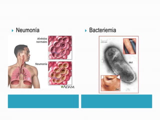  Neumonía  Bacteriemia
 