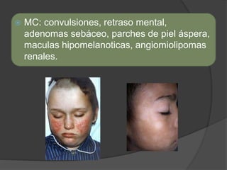  MC: convulsiones, retraso mental,
adenomas sebáceo, parches de piel áspera,
maculas hipomelanoticas, angiomiolipomas
renales.
 