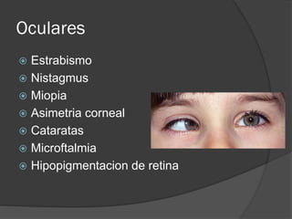 Oculares
 Estrabismo
 Nistagmus
 Miopia
 Asimetria corneal
 Cataratas
 Microftalmia
 Hipopigmentacion de retina
 
