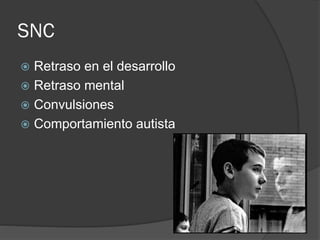 SNC
 Retraso en el desarrollo
 Retraso mental
 Convulsiones
 Comportamiento autista
 
