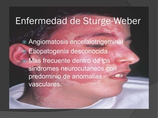 Enfermedad de Sturge-Weber
 Angiomatosis encefalotrigeminal
 Etiopatogenia desconocida
 Mas frecuente dentro de los
sindromes neurocutaneos con
predominio de anomalias
vasculares.
 