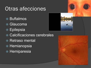 Otras afecciones
 Buftalmos
 Glaucoma
 Epilepsia
 Calcificaciones cerebrales
 Retraso mental
 Hemianopsia
 Hemiparesia
 