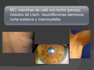  MC: manchas de café con leche (pecas),
nódulos de Lisch, neurofibromas dermicos,
corta estatura y macrocefalia.
 