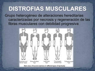 DISTROFIAS MUSCULARES
Grupo heterogéneo de alteraciones hereditarias
caracterizadas por necrosis y regeneración de las
fibras musculares con debilidad progresiva
 