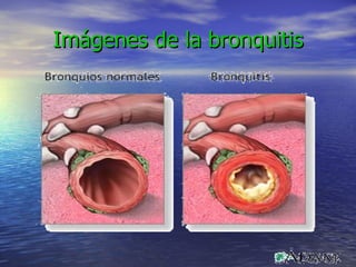 Imágenes de la bronquitis 