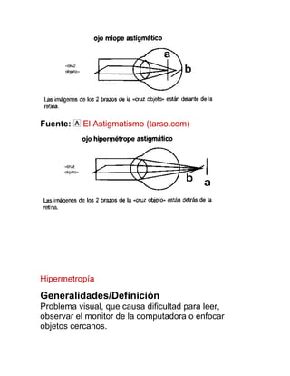 Fuente:    El Astigmatismo (tarso.com)




Hipermetropía

Generalidades/Definición
Problema visual, que causa dificultad para leer,
observar el monitor de la computadora o enfocar
objetos cercanos.
 