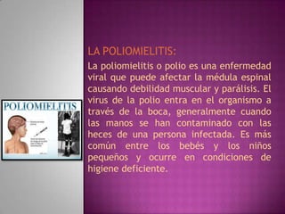 LA POLIOMIELITIS:
La poliomielitis o polio es una enfermedad
viral que puede afectar la médula espinal
causando debilidad muscular y parálisis. El
virus de la polio entra en el organismo a
través de la boca, generalmente cuando
las manos se han contaminado con las
heces de una persona infectada. Es más
común entre los bebés y los niños
pequeños y ocurre en condiciones de
higiene deficiente.
 